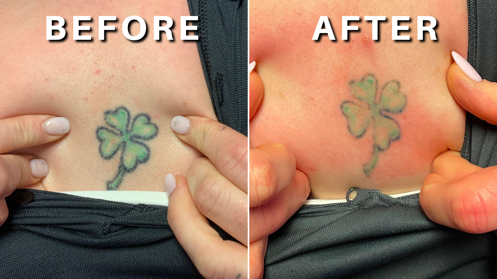 Laser Tattoo Removal Treatments | Sacramento CA