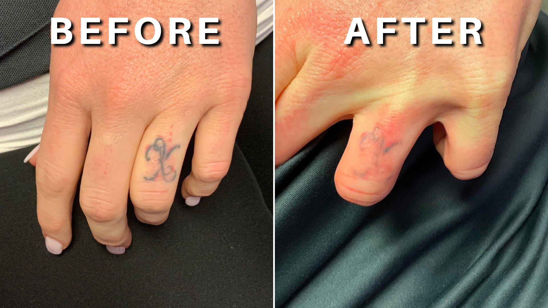 Tattoo Removal - Before & After Pictures of Our Patients at VIVAA